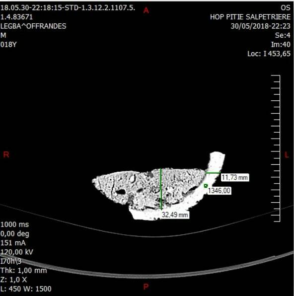 Fig2. a Scanner céramique avec densités