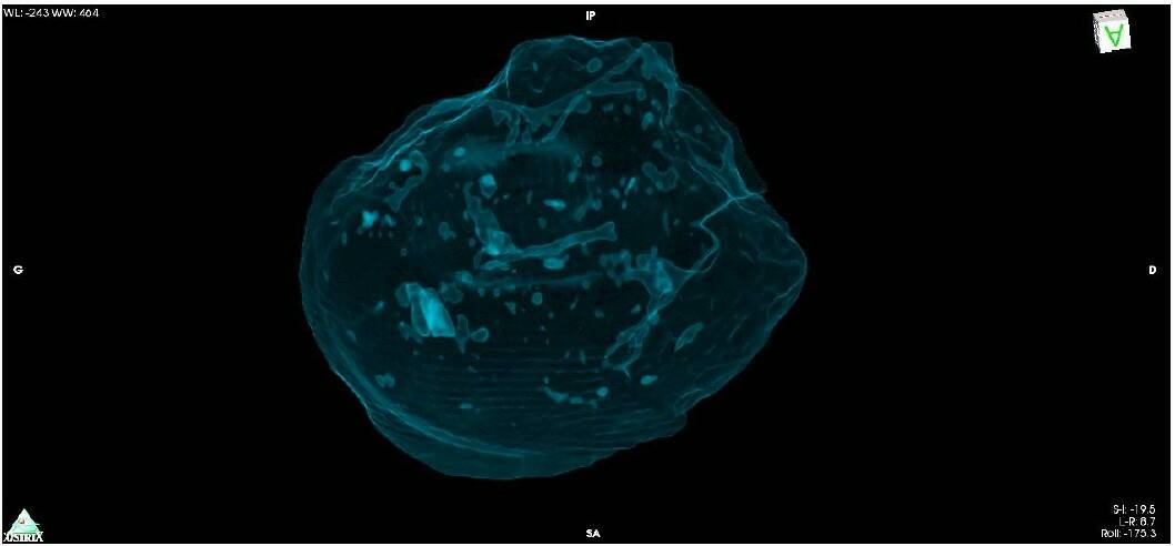 Fig2 d Image scannographique – vue supérieure